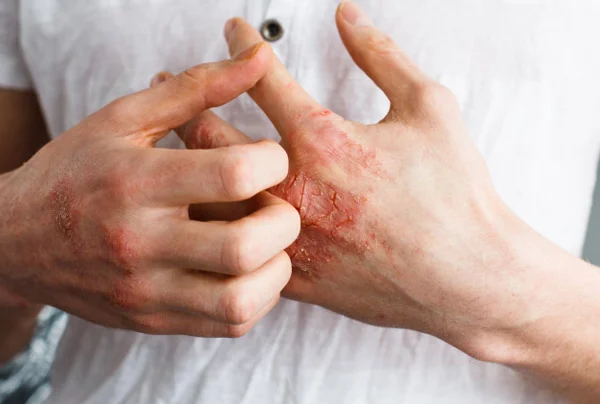 Eczema